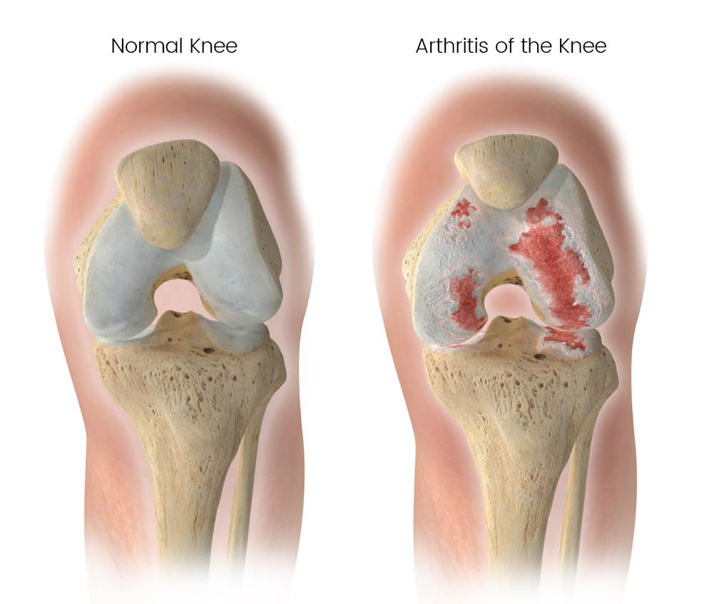 Knee Arthritis Leeds Knee and Hip